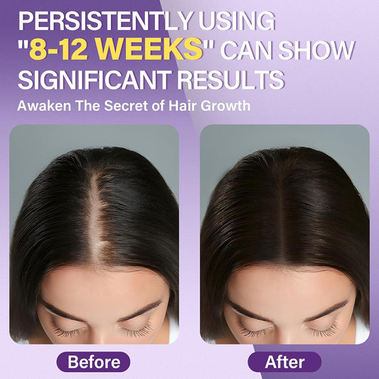 5% Minoxidil Foam for Women Hair Growth Foam Suitable for Hair Thinning Receding Hairline and Hair Loss to Hair Regrowth Get Thicker Fuller Hair 1 Bottles 2.11 Ounces Each