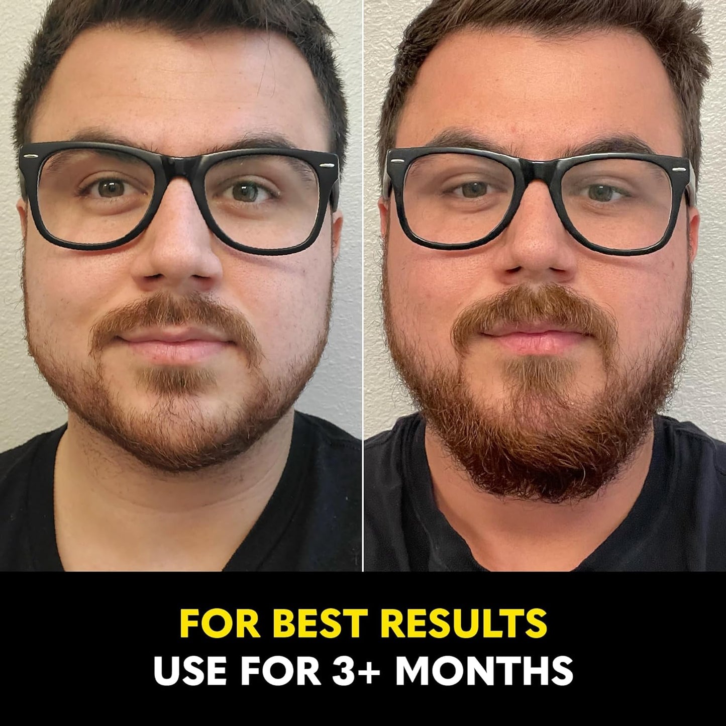 The Beard Club - Biotin Beard Growth Vitamins - Support A Thicker Fuller Beard, Fill in Patches - Minerals & Multi-Vitamins Help Support and Stimulate Healthier Facial Hair Growth