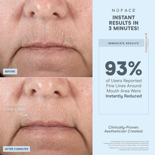 NuFACE FIX Line Smoothing Starter Kit - FDA Cleared Microcurrent Device + Serum Activator for On-The-Go Treatment of Forehead Lines, Crow's Feet, Under Eyes, Smile & Fuller-Looking Lips