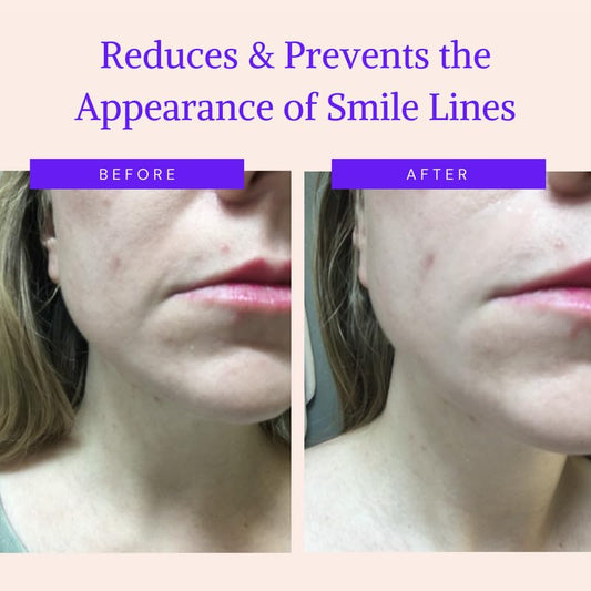 BLUMBODY Face Wrinkle Patches - Anti Wrinkle Facial Patches to Smooth Smile Lines - Non-Silicone Face Patches Wrinkles Tape for Fine Wrinkles between Eyes & Face - For Overnight Wrinkle Use