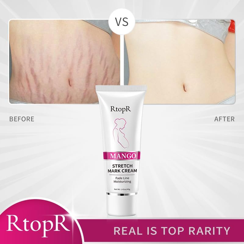 Stretch Mark Removal Cream, Obesity Stretch Mark Moisturizer, Postpartum Repair Stretch Mark Cream, Abdominal Stretch Mark Cream, Remove Marks (1 PCS)