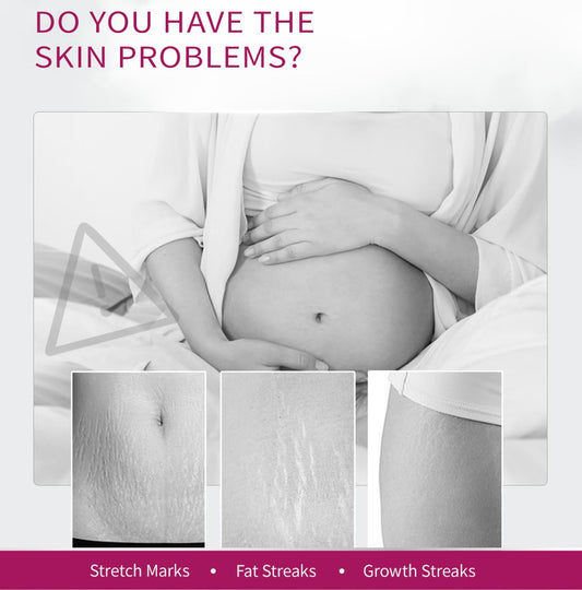Stretch Mark Removal Cream, Obesity Stretch Mark Moisturizer, Postpartum Repair Stretch Mark Cream, Abdominal Stretch Mark Cream, Remove Marks (1 PCS)