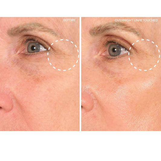 SiO Beauty SuperLift Forehead, Eye, & Lip Anti-Wrinkle Silicone Patches - Reduce Brow, Smile, and Under Eye Wrinkles Overnight