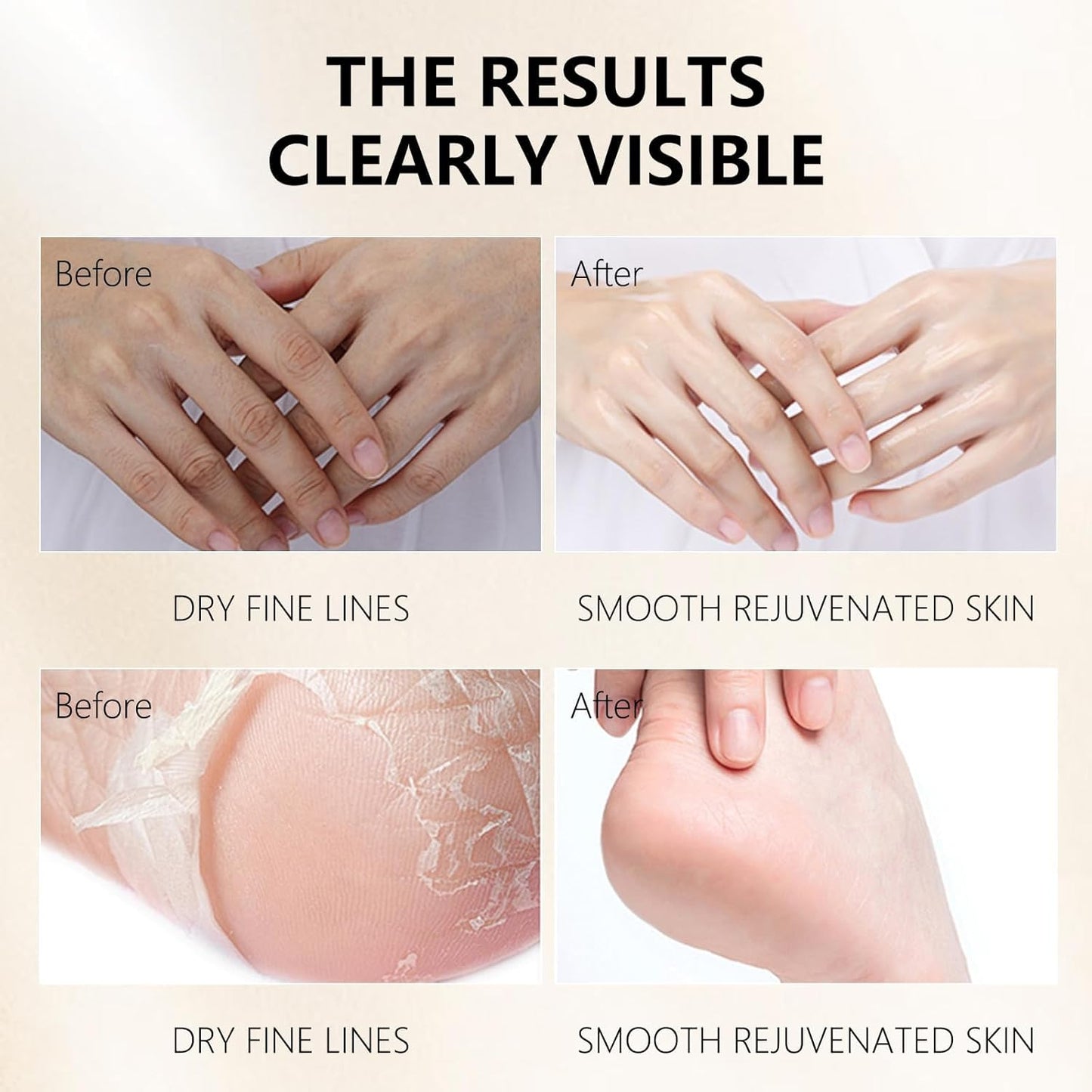 Hydrating Hand Foot Masks Set for Women Men,6 Pack Glove Mask for Dry Hand & 6 Pack Socks Mask for Dry Cracked Feet（Milk）