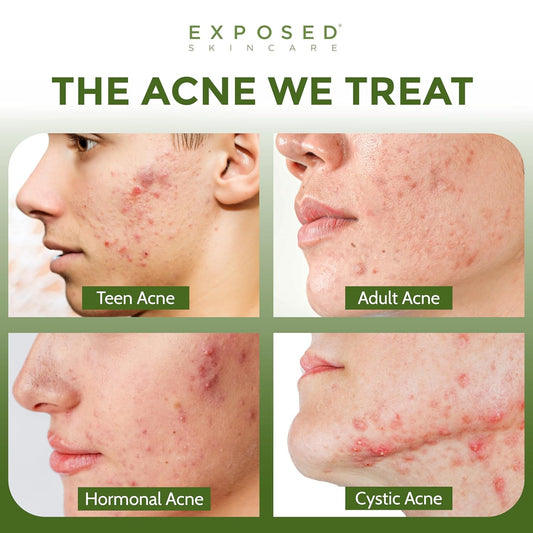Exposed Skin Care Acne Facial Cleanser – Gentle Salicylic Acid Face Wash for Acne-Prone Skin – Pore Clarifying Wash for Teens & Adults, All Skin Type