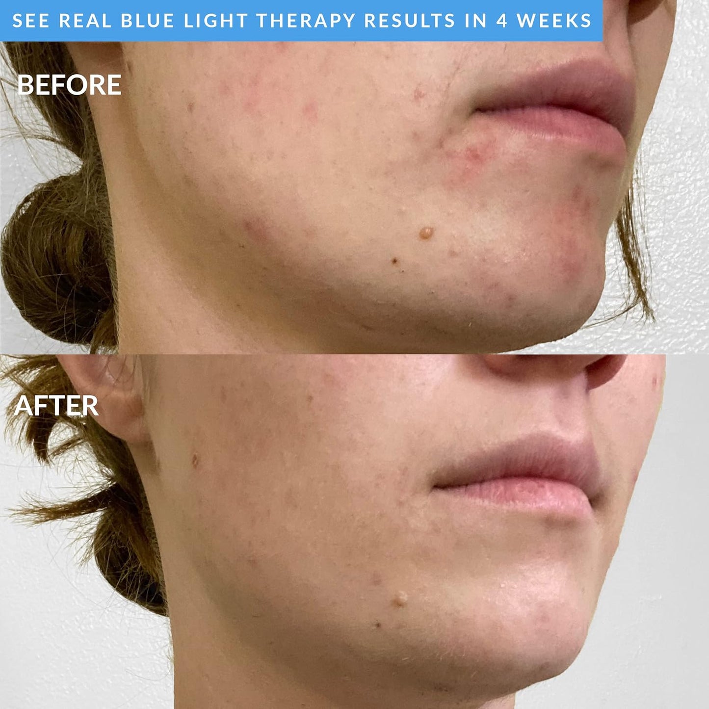 PMD Beauty Facial Cleansing Brush - Smart Silicone Brush with Blue Light Treatment - SonicGlow Vibration - Waterproof Device for Acne