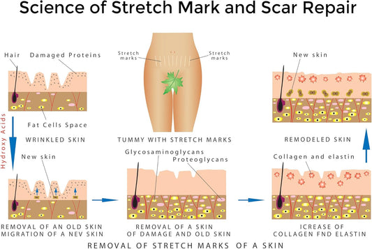Best Stretch Marks Cream Prevent & Reduce Marks Reduce Pregnancy Stretch Marks Highly Concentrated Cream includes $29 Scar Reducing Guide