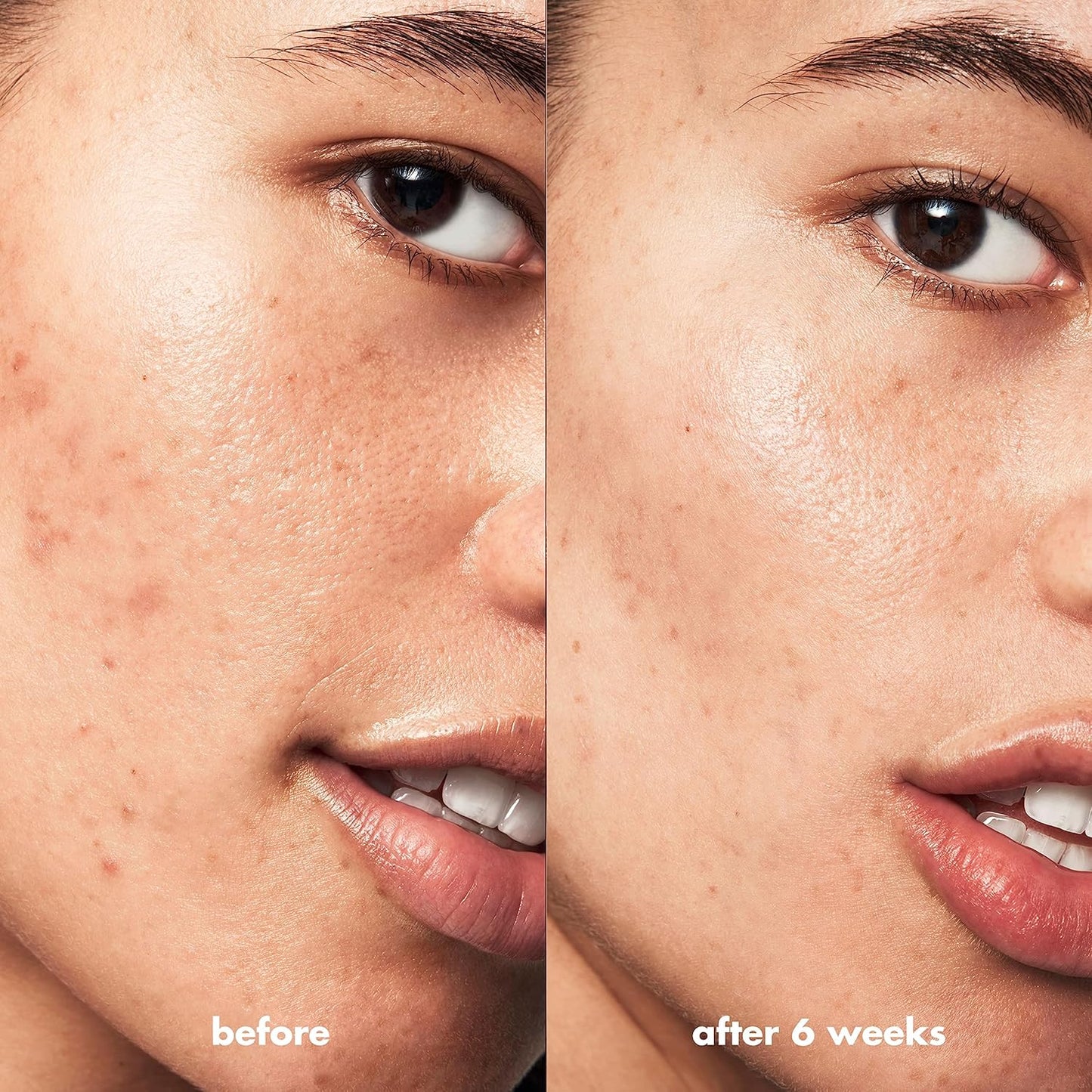 e.l.f. SKIN Blemish Breakthrough Blemish Control Basics Kit, Travel-Size Acne Skincare Routine, Cleanser, Serum & Moisturizer, Vegan & Cruelty-Free